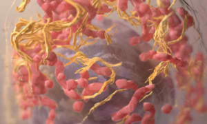 Cholesterol melanoma Spread